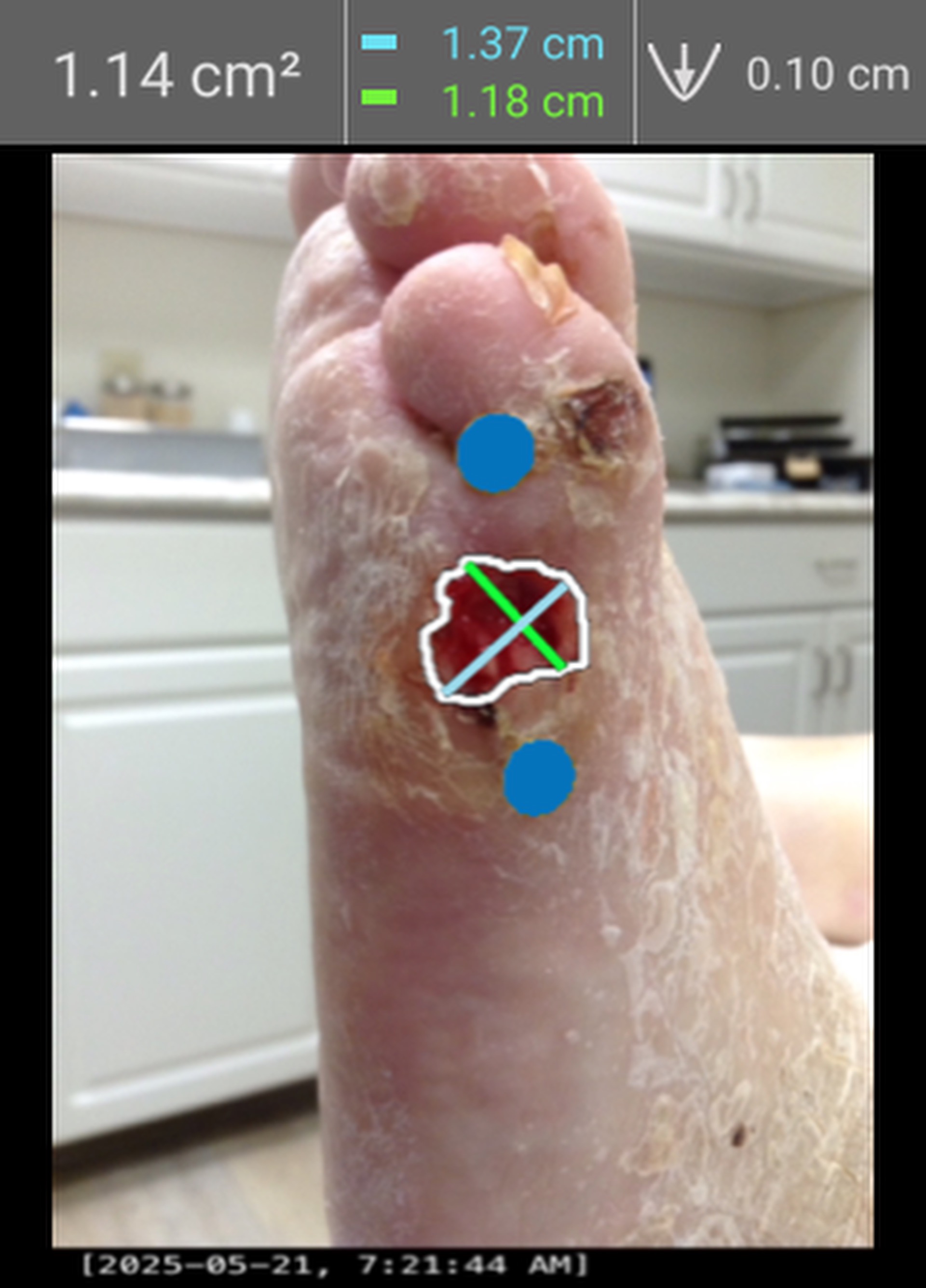 Study wound image at treatment visit 1