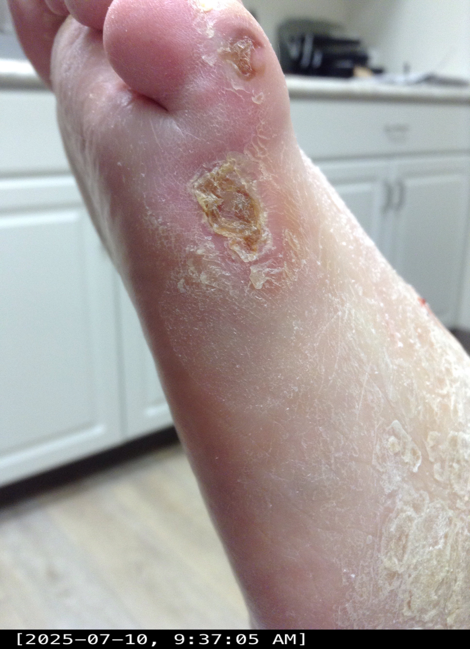 Study wound image at closure confirmation visit