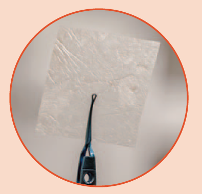Figure 1. Representative image of the full-thickness placental membrane allograft (FT; caregraFT™, Tiger Wound Care Medical, LLC, Conshohocken, PA, US) used in the TIGERCAMP DFU interim analysis. Figure 1. Representative image of the full-thickness placental membrane allograft (FT; caregraFT™, Tiger Wound Care Medical, LLC, Conshohocken, PA, US) used in the TIGERCAMP DFU interim analysis.